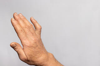 Artrosje eller slitasjegikt kan være smertefullt. Men det fins håp. Her kan du lese mer om hva artrose er og hvordan du kan trene hendene.